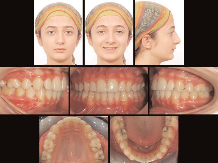 Gömülü Kanin Vakas n n Tedavisi Treatment of an Impacted Canine Case Treatment Progress In first six months, rotations of molars and premolars were corrected.