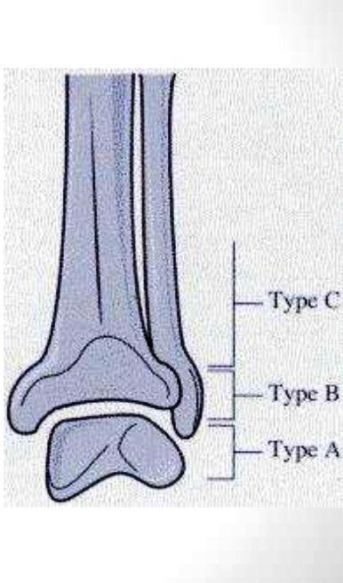 *Dennis- Weber Sınıflaması Tip A: Tibiotalar eklem seviyesinin altında kırık Tip B: