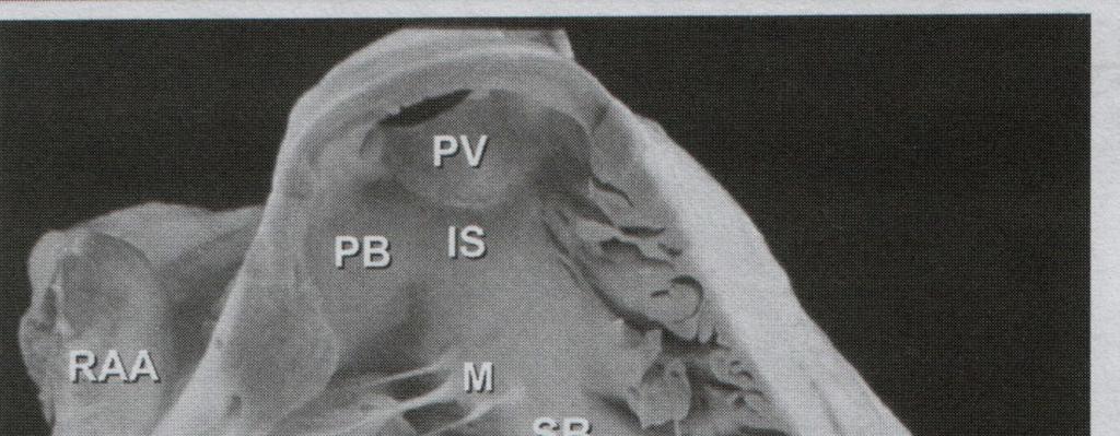 4 A B Şekil 1. A. Sağ ventrikül serbest duvarı çıkartılarak parietal