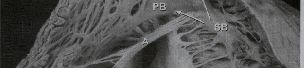 M, medial triküspid adale; PV, pulmoner kapak; RAA, sağ atriyal