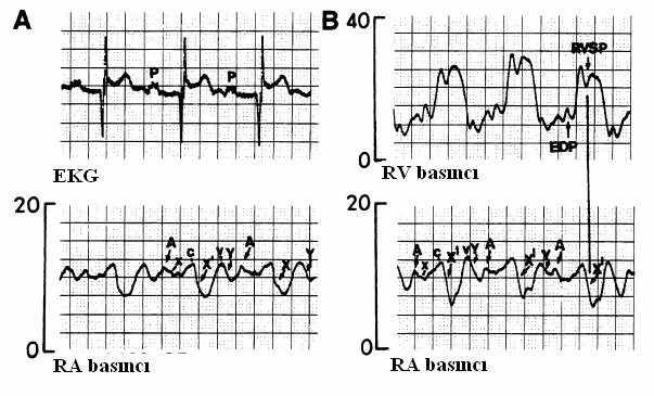 9 Şekil 3. Sağ atriyumun M dalga formu izlenmektedir. EKG ile eş zamanlı kayıt alındığında sağ atriyum belirgin negatif defleksiyonu T dalgası ile birliktelik göstermektedir.
