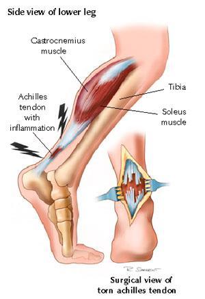 Tendon ve