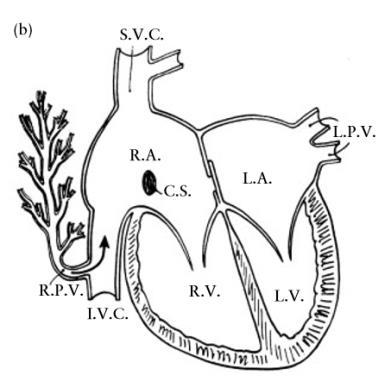 Parsiyel Pulmoner Venöz Dönüş Anomalileri Sağ pulmoner venler VCS Bunlarda genelde sinüs venozus tipi ASD VCİ Genelede ASD yoktur Sağ akciğer genelde tek venle drene olur Sağ pulmoner arter