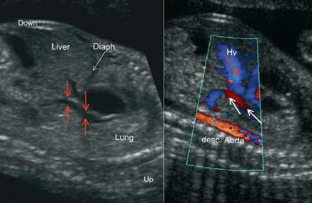 Total Pulmoner Venöz Dönüş Anomalileri