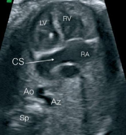 Total Pulmoner Venöz Dönüş Anomalileri Tipleri Tip