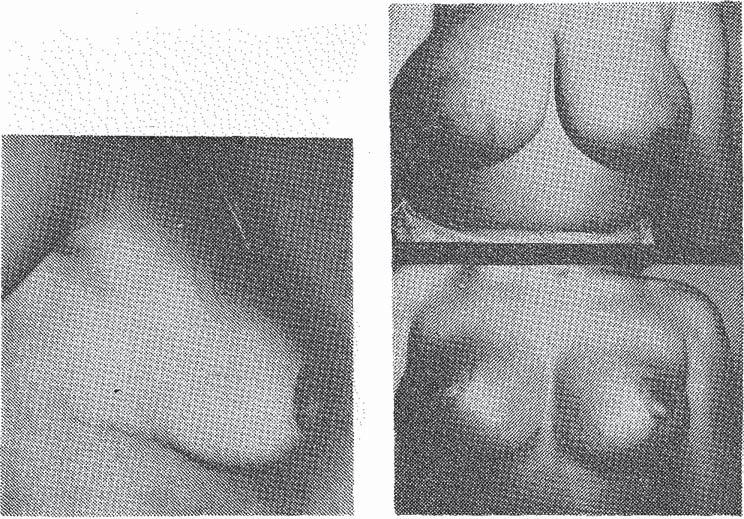 Postoperatif devrelerde bu hastalarda çukur ve ekseriyetle aşağıya doğru dönük meme başı oluşuyordu.