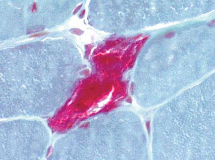 anormal mitokondrilerin kas lifinde aşırı