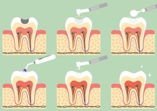 Kompozit rezin esaslı dolgulardır. Hamur kıvamındaki materyal diş üzerindeki çürük dokuların temizlenmesini takiben açılan kaviteye (oyuğa) yerleştirilir ve led ışıkla sertleştirilir.