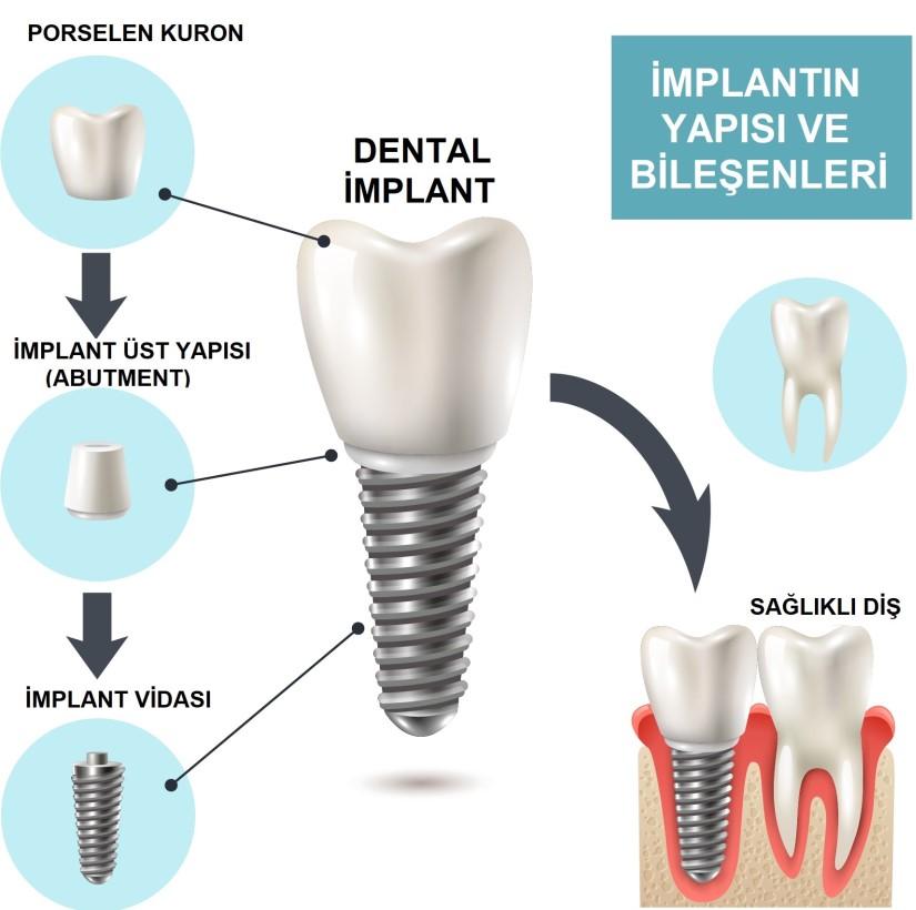 Randevu Almak için Arayın: 0 505 402 41 41 ve 0 262 644 91 62 İMPANT TEDAVİSİ VE FAYDALARI İmplant Tedavisi Eksik dişleri tamamlamak için çene kemiğine yerleştirilen doku dostu medikal vidaya implant