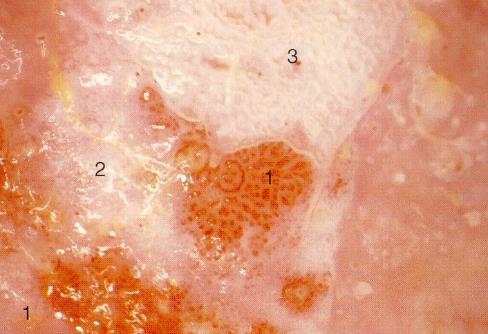 viral, neoplazi, konjenital