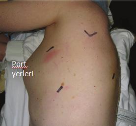 Toraks boşluğuna uygulanan minimal invaziv cerrahi VATS (video assisted thoracoscopic surgery) veya RATS (robotic assisted thoracic surgery) adıyla kullanılmaktadır.
