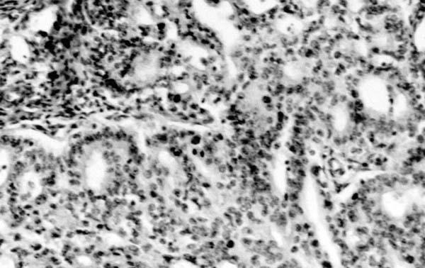 Ki-67 PI, endometriumun proliferasyon ve sekresyon fazı ile hiperplazilerine göre endometrioid karsinomda belirgin artış göstermekteydi. Bu artış istatistiksel açıdan anlamlı idi (p<0,05).