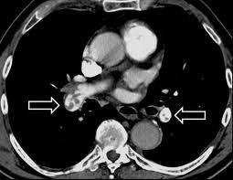 Bilateral proksimal