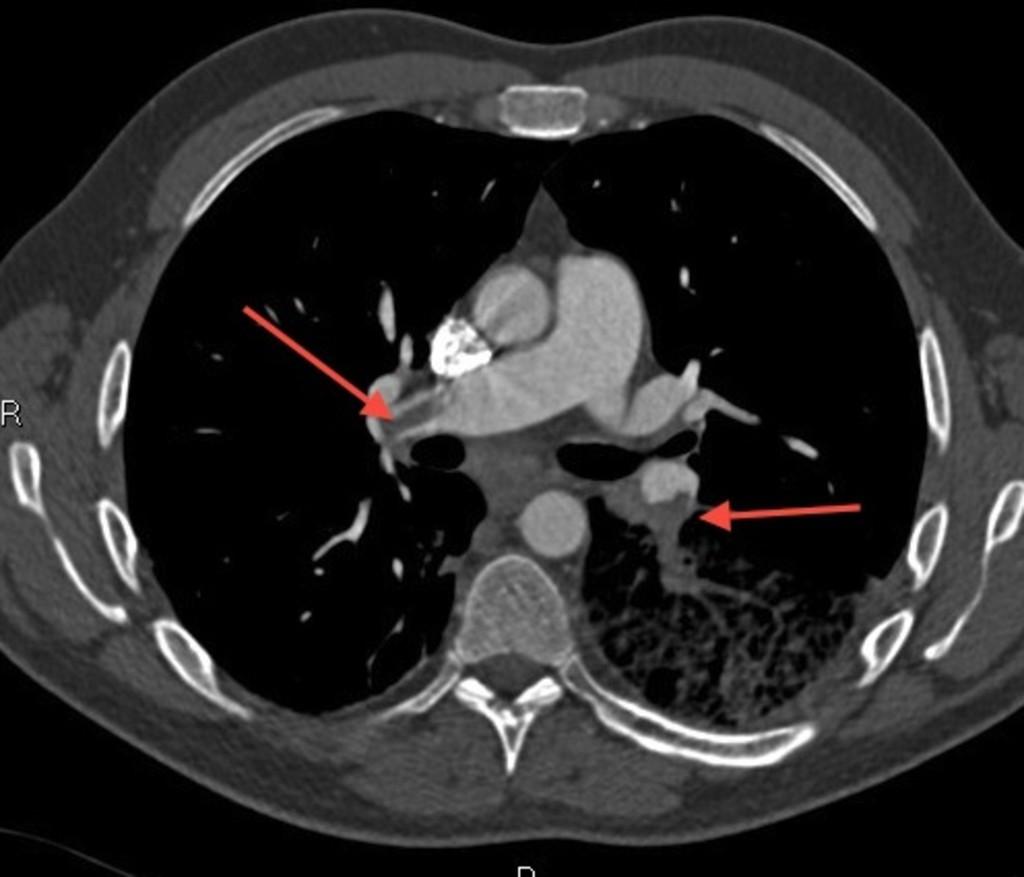 Sağ pulmoner arter ve sol