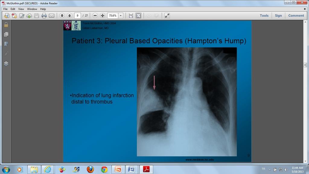 PTE nin başlıca akciğer grafisi bulguları; İpsilateral