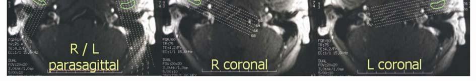 Araştırmamızda kullanılan sagittal tarama parametreleri Sagittal MRG SE T1 FSE T1 T2* GRE 25 STIR TR(msec) 350 600 425 3500