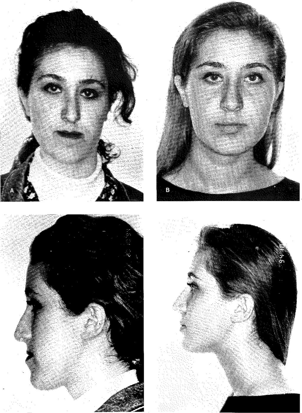 ) preoperatif yüz cephe görünümü, b: Aynı hastanın
