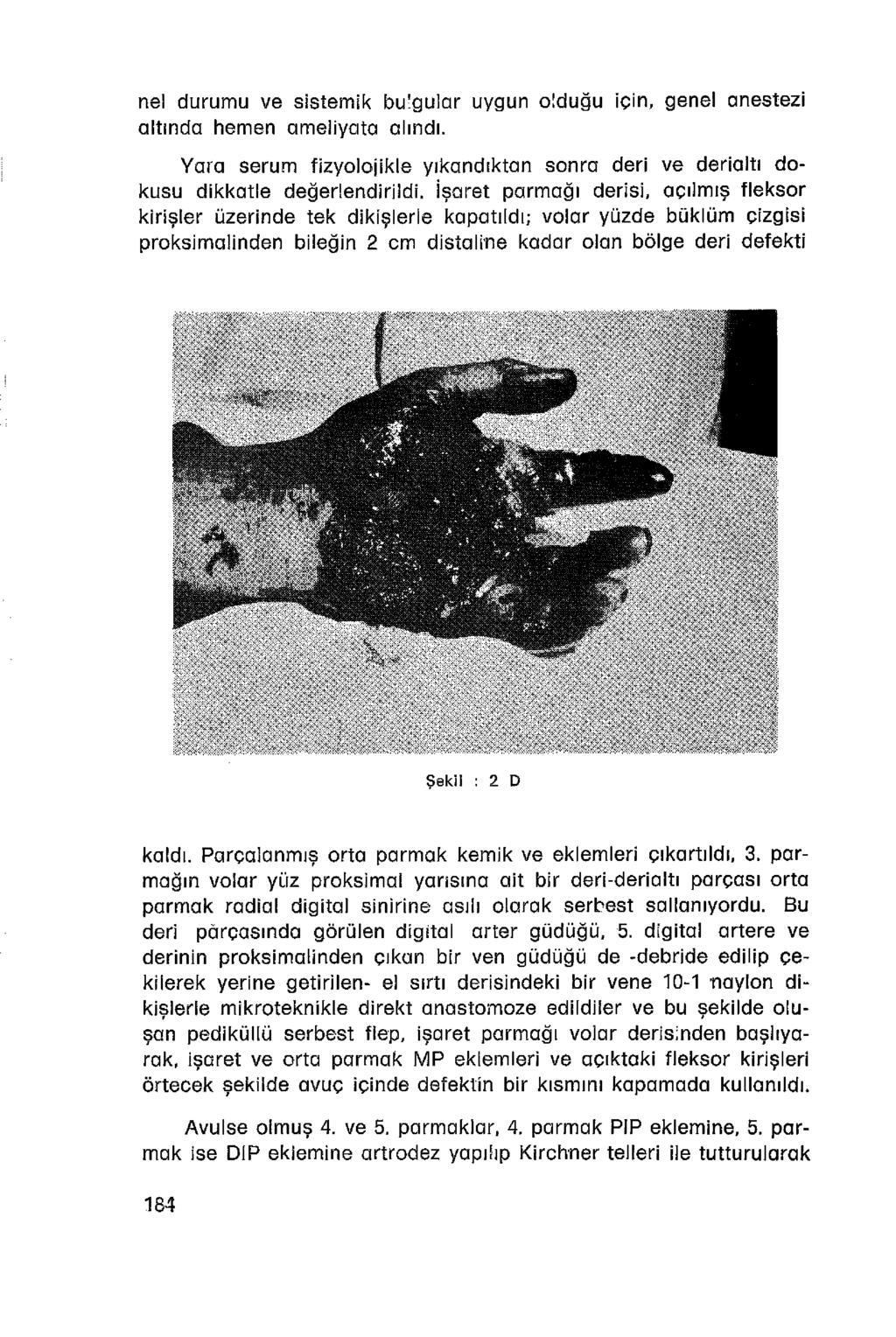 nel durumu ve sistemik bulgular uygun olduğu için, genel anestezi altında hemen ameliyata alındı. Yara serum fizyolojikle yıkandıktan sonra deri ve derialtı dokusu dikkatle değerlendirildi.