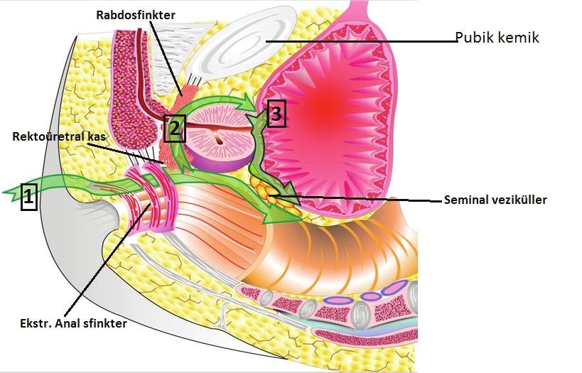 2 Perineal Radikal Prostatektomi Operasyon sırasında prostatın ve rektum duvarının steril şekilde palpasyon ve manipulasyonunu mümkün kılmak için, bir steril eldivenin bileklik kısmı anüs çevresine