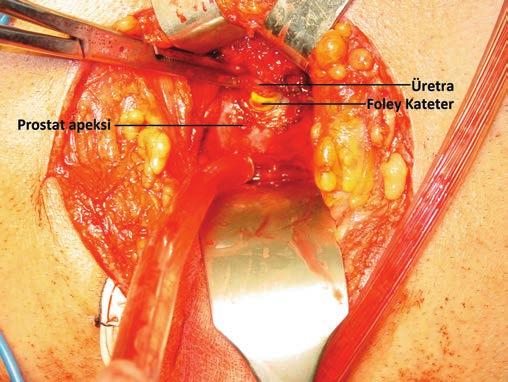 2 Perineal Radikal Prostatektomi Resim 3. Apikal diseksiyon ve membranöz üretranın transseksiyonu. içinde ekartör ya da kateter bulunan membranöz üretra kolaylıkla palpe edilir.