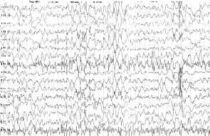 81 Epilepsi Cilt 12, Say 2-3, 2006 fiek L 3 Olgu 2 nin elektroensefalografisinde yavafl bir zemin aktivitesi üzerinde sa da belirgin olmak üzere oksipital dikenler görülmektedir.