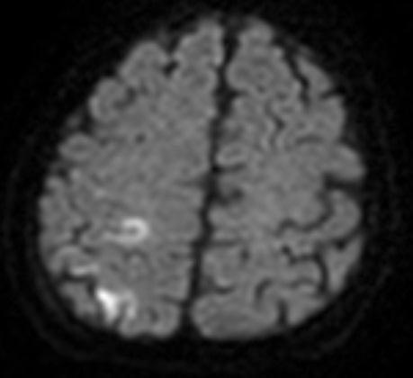 SAK ile prezente olan serebral ven trombozu Resim 3-4: Presantral gyrusta ve superior pariyetal gyrusta diffüzyon ağırlıklı görüntülerde hiperintens, ADC haritasında hipointens difüzyon kısıtlanması