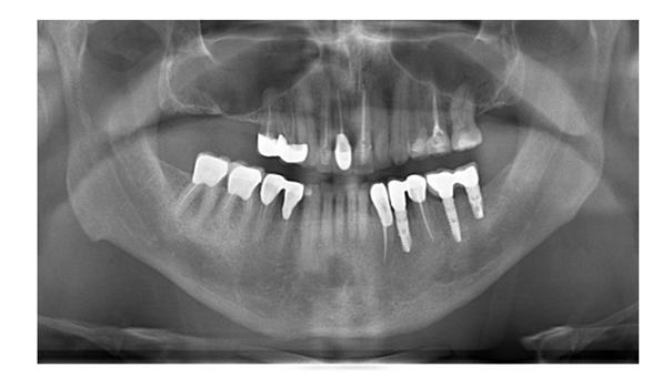 62 GİRİŞ Modern diş hekimliğinde diş eksikliğinin rehabilitasyonunda dental implantlar en çok kullanılan yöntemlerden biridir.