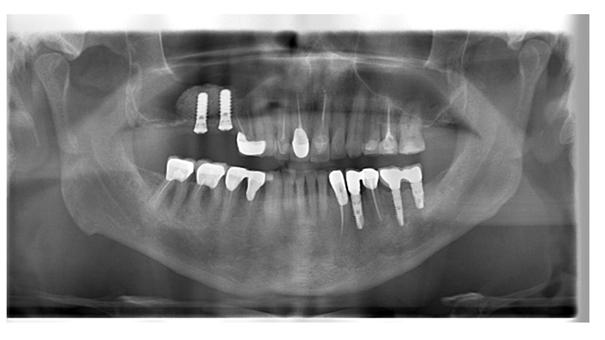Konvansiyonel tedavi protokolünde dental implantlar yerleştirildikten sonra 3 ile 6 aylık iyileşme süresinin ardından protetik safhaya geçilmektedir.