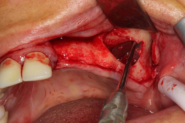 Maksiller sinüsün lateral duvarında pencere açılırken posterior superior alveolar arterin geçiş yolu dikkate alınarak pencere kret tepesinden yukarıda 5-16 mm aralığında hazırlanmıştır.