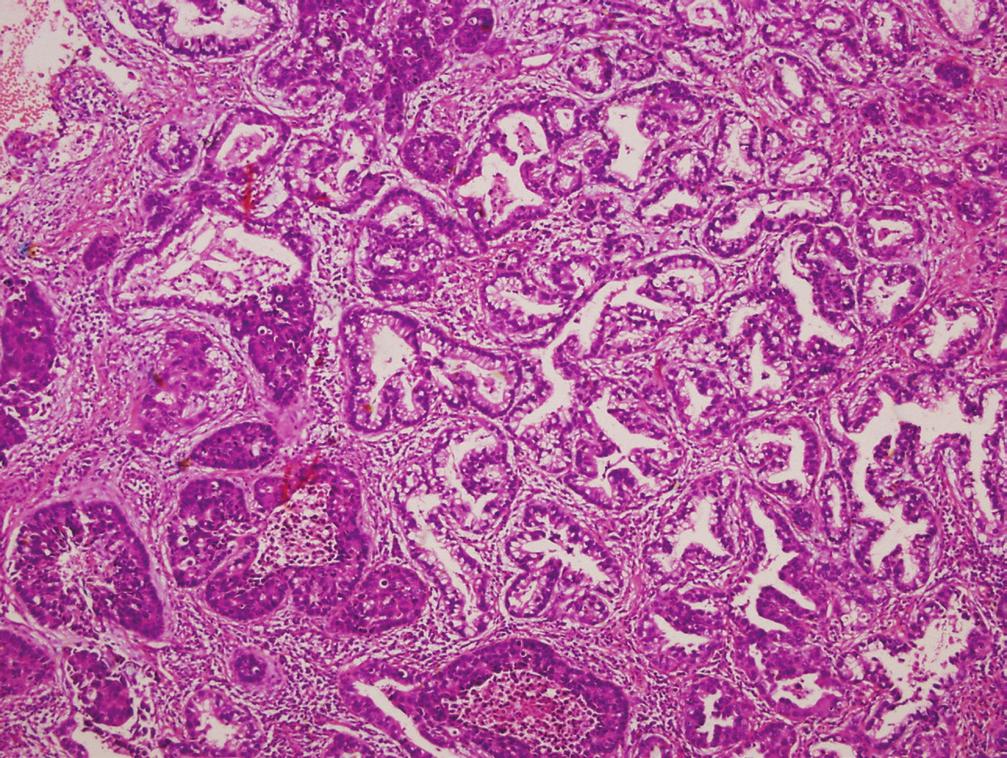 Sklerozan hemanjiom, inflamatuvar miyofibroblastik tümör tanı sorunu yaratabilir (23). Nekrotik maligniteler ve granülomlar karışabilir, çok sayıda kesit alınmalıdır.