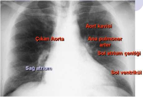 1.8. Kalp Radyografilerinde Anatomik Yapı Kalbin direkt