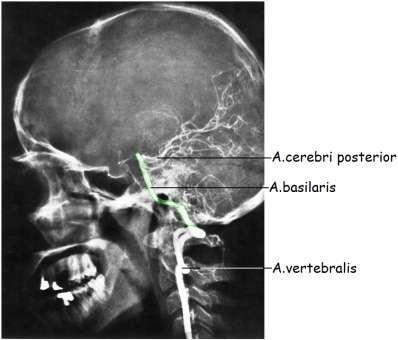 A-P arteriogramı 13: