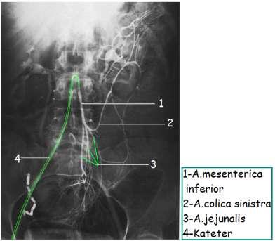 2.6. Pelvisin Arteryel Kanlanması Resim 2.28: Alt mezenterik arteriogram, A-P L4 hizasında, aorta abdominalisin sonlanmasıyla ayrılan a.iliaca communis dextra ve a.