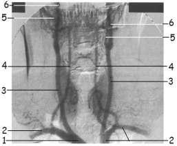 Boyun arterlerini arteriogramda gösteriniz.