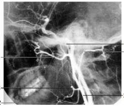Eksternal karotis arterin dallarını arteriogramda