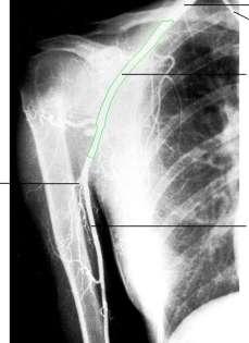 Omuz bölgesi arteriogramnda arterleri