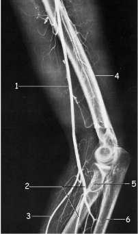 Kol ve ön kol bölgesi arteriogramında arterleri