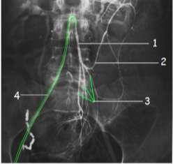 Alt mezenterik arteriogramda arterleri gösteriniz.