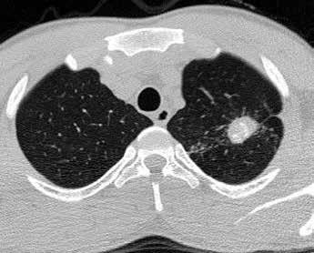 Sentrlobüler Nodüller ve Tomurcuklu Ağaç Görünümleri İnflamatuar lezyonların bronşiyolleri ve komşu alveolleri etkilemesi sonucu gelişmektedir.