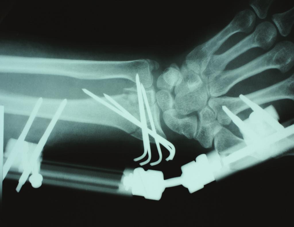 46 yaşında bayan hasta, araç dışı trafik kazası sonrasında sağ el bileği üzerine düşme sonucunda sağ distal radius kapalı, AO C1,2, Frykman Tip 7 kırık gelişmiş (Resim 1, 2).