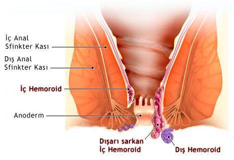 bireyde bulunan damarsal yapıların aşırı