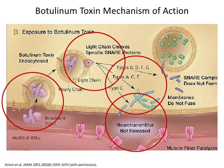 Botulinum toksin tip A uygulaması Fokal spastisitede kullanılır, Clostridium Botulinum tarafından üretilir Toksin ağır ve hafif olmak üzere iki protein zinciri icerir.