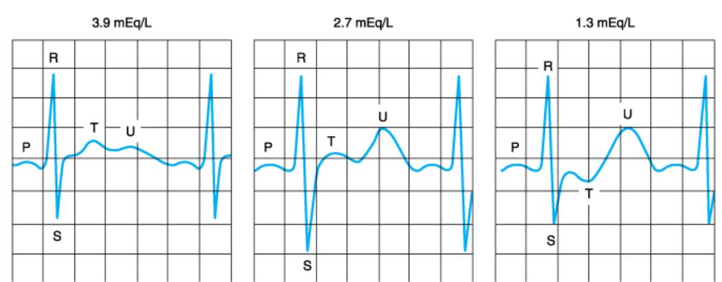 Hipokalemide EKG T dalgasında progresif düzleşme Giderek belirginleşen U