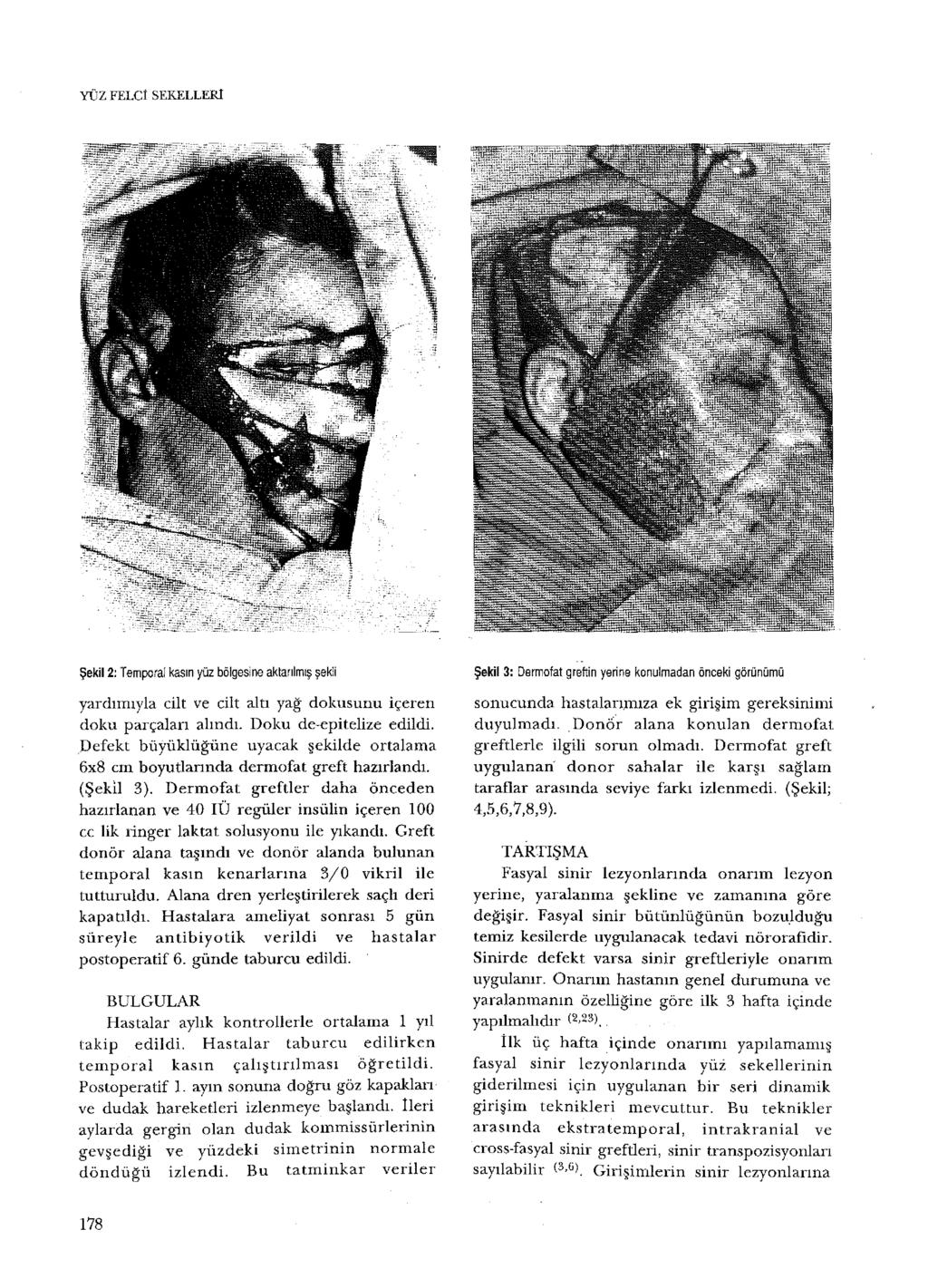 YÜZ FELCİ SEKELLERl Şekil 2: Temporal kasın yüz bölgesine aktarılmış şekli yardımıyla cilt ve cilt altı yağ dokusunu içeren doku parçalan alındı. Doku de-epitelize edildi.