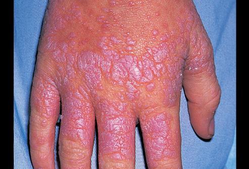 HCV ve Dermatolojik Bulgular Lichen planus -Tekrarlayan