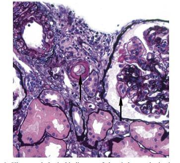 Kronik Antikor Aracılı Rejeksiyon Histolojik olarak transplant glomerulopati ve/veya vaskulopati görülür DSA varlığı eşlik eder ve prognozun daha kotu olduğunu gösterir Eski ismi kronik allograft