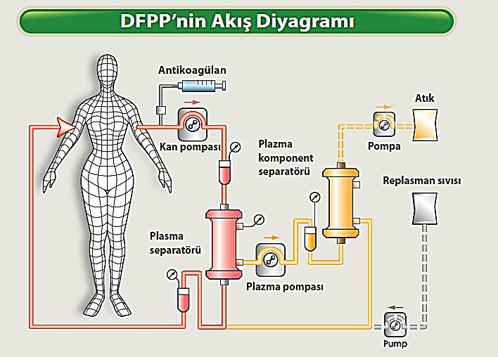 KASKAD FİLTRASYON-CF/ DUBLE FİLTRASYON PLAZMAFEREZİ-DFPP- 1 Plazma, filtre ile ayrılırsa işlem DFPP, santrifüj ile ayrılırsa CF (Kaskad filtrasyon) olarak adlandırılır.