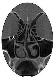 Ön ethmoid hücrelerin frontal resese doğru pnömatizasyon gösterdiği Agger nazi hücreleri (yıldız), koronal kesitte bilateral olarak izlenmektedir. Resim 2.