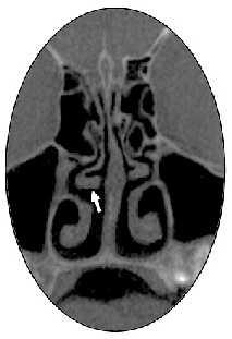 sagittal (C) kesitlerde solda izlenmektedir.(s; sfenoid sinüs). Resim 5.