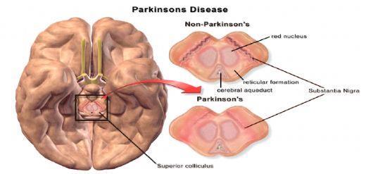 Parkinson hastalığı (Parkinson Disease, PD): Parkinson hastalığı (PD), yaşa bağlı olarak nörodejenerasyon